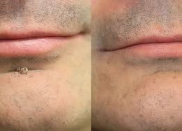 🔥Elmstr®2-in-1 Microneedle & Hydrocolloid Patch🍀| Removes Raised Moles, Acne, Flat Warts & Skin Tags | Helps Improve Wrinkles, Scars & Blemishes | Invisible Patches for Face & Body