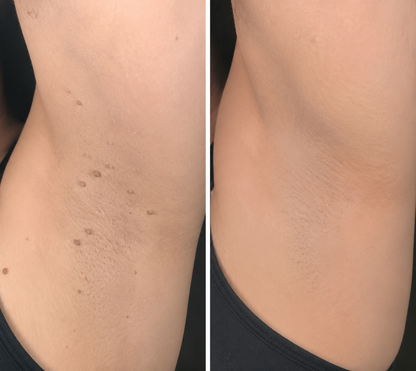 🔥Elmstr®2-in-1 Microneedle & Hydrocolloid Patch🍀| Removes Raised Moles, Acne, Flat Warts & Skin Tags | Helps Improve Wrinkles, Scars & Blemishes | Invisible Patches for Face & Body
