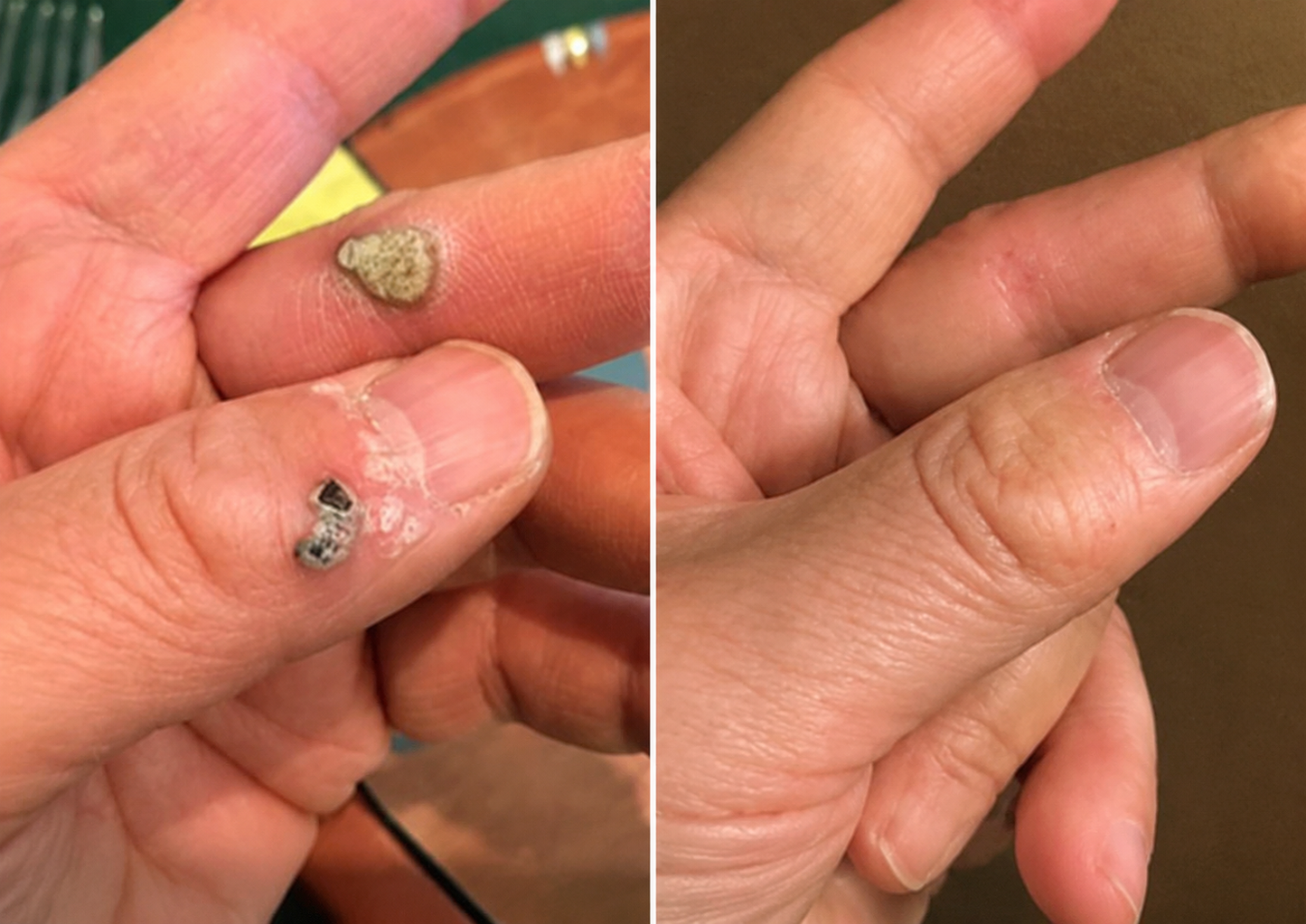 🔥Elmstr®2-in-1 Microneedle & Hydrocolloid Patch🍀| Removes Raised Moles, Acne, Flat Warts & Skin Tags | Helps Improve Wrinkles, Scars & Blemishes | Invisible Patches for Face & Body